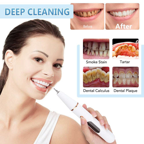 True Ultrasonic Dental Cleaner - Smart Stain & Tartar Remover Soloist