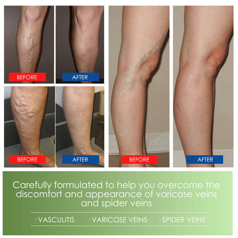 Vein Repair Cream - Varicose Legs Relief & Massage Care Soloist